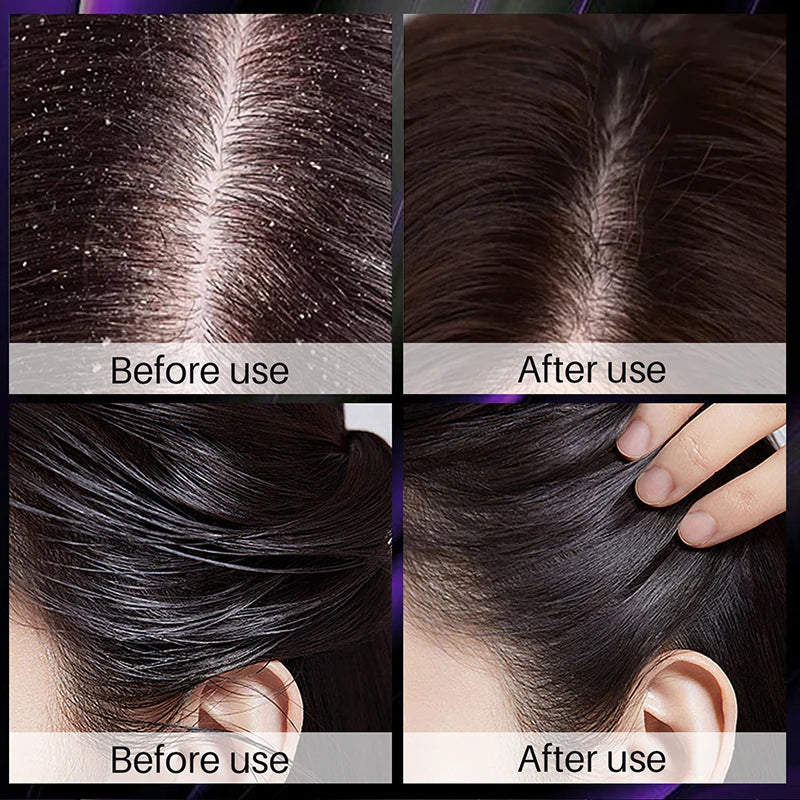 Hair scalp with dandruff before using rosemary onion shampoo